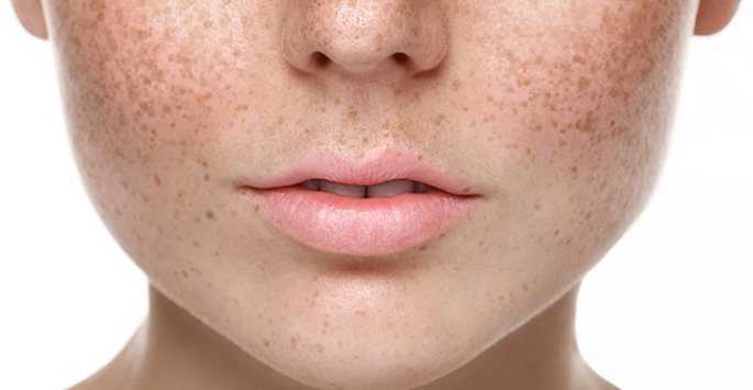 cach-tri-nam-da-va-tan-nhang-6-melasma.jpg