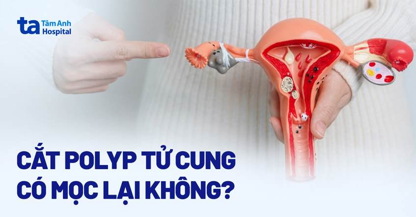 cat-polyp-tu-cung-co-moc-lai-khong.jpg