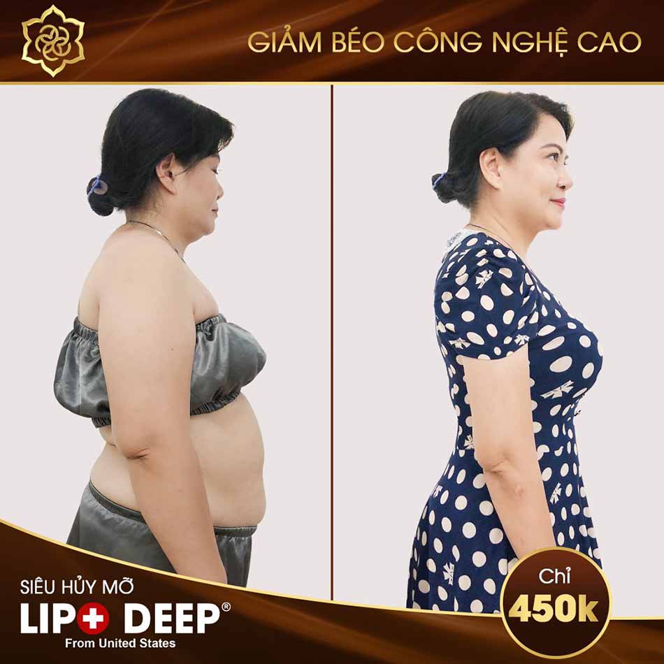 khach-hang-su-dung-cong-nghe-lipo-deep.jpg