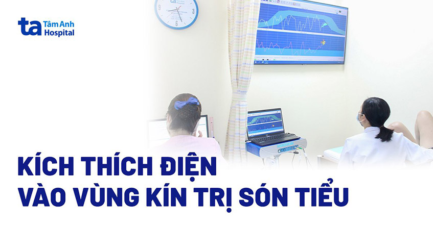 kich-thich-dien-dieu-tri-son-tieu.jpg