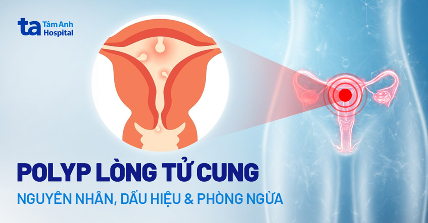 polyp-long-tu-cung.jpg